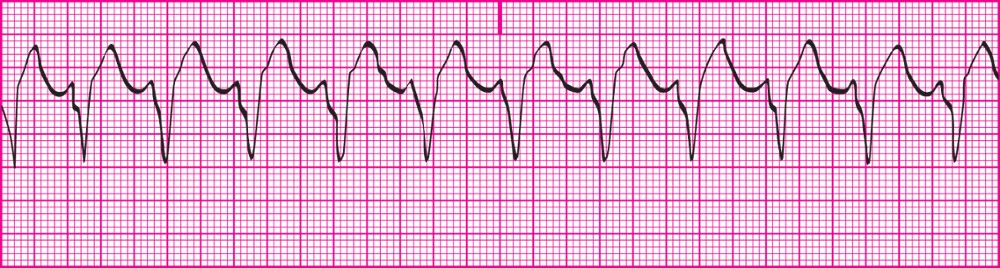 <p>Occurs when there is 3 or more PVCs in a row &amp; the HR is over 100bpm; Ventricles are continously contracting &amp; relaxing with no period of repolarization.</p><p></p><p>Rhythm: P-P interval usually not identifiable; R-R interval usually regular, can be slightly irregular at times.</p><p>Rate: Ventricular rate- 100‒200 beats per minute; Atrial rate- Cannot be determined</p><p>P wave: Absent</p><p>PR interval: Cannot be determined</p><p>QRS: Duration greater than 0.12 second; Wide, bizarre appearance; T wave in opposite direction (usually down) from QRS complex</p><p></p><p>Lost atrial kick and decreased ventricular filling time result in decreased cardiac output.</p><p>Approximately 50% of patients become unconscious immediately.</p><p>Notify licensed practitioner immediately.</p><p>Save rhythm strips in medical record to document rhythm changes.</p>