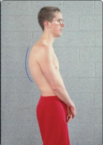 Kyphosis