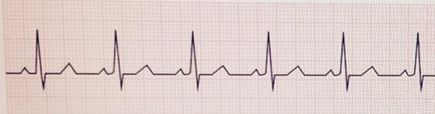 <p>The heart rate is 75/min</p>