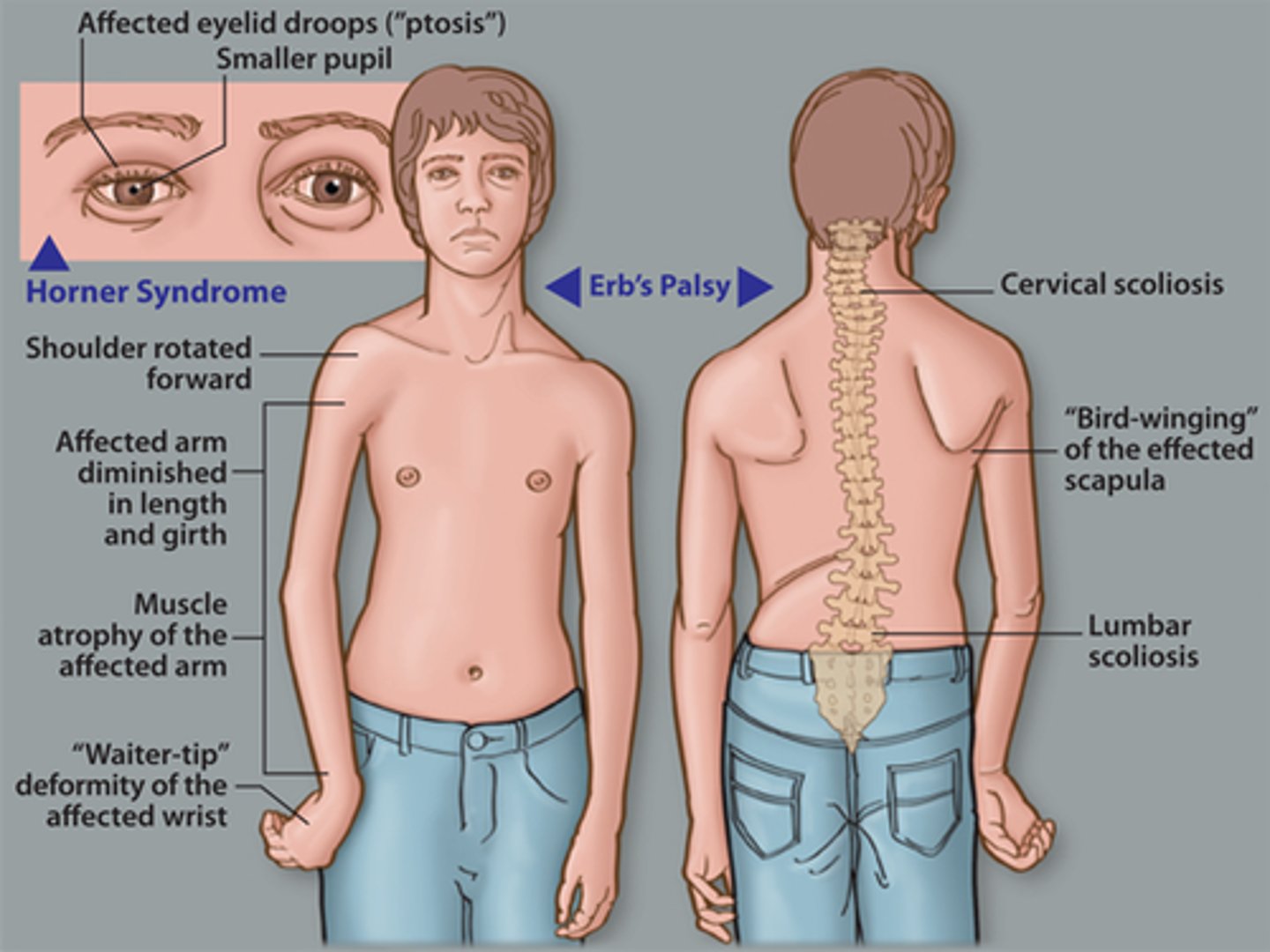 <p><strong>"erbs palsy"</strong> </p><p>-upper brachial plexus injury (superior trunk) </p><p>-waiters tip (int. rotated and hanging at side) </p><p>-C5, C6 </p>