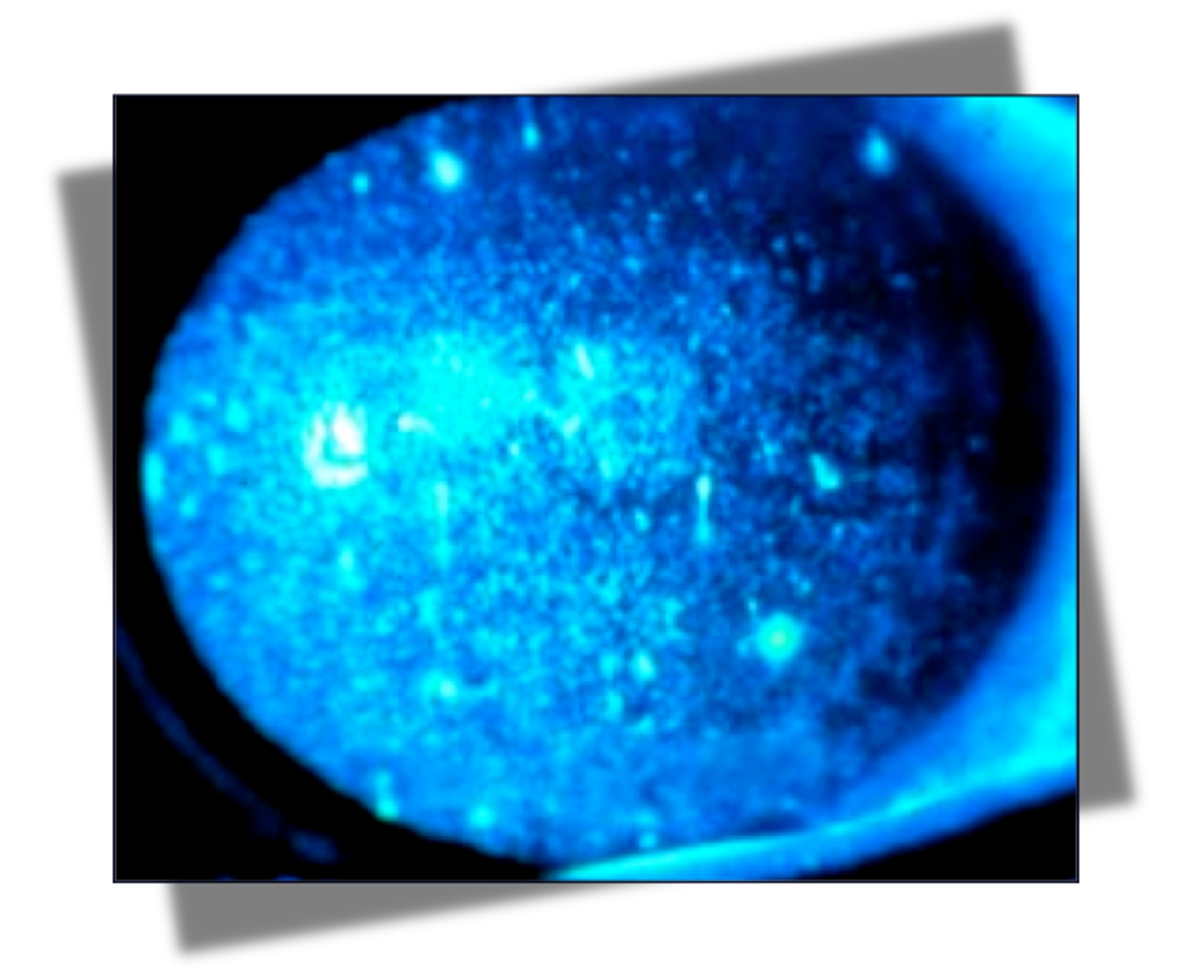 <p>fluorescein - diffuse punctate staining to both cornea</p>