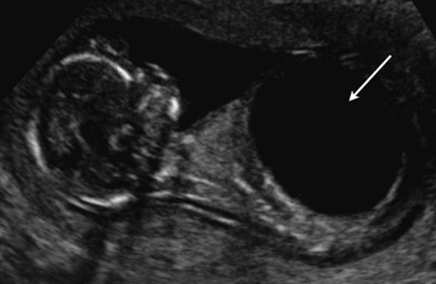 <p>Megacystis is an enlarged bladder. It has a similar etiology to hydronephrosis, but can be diagnosed earlier and is more likely to result in spontaneous abortion. The main cause is bladder outlet obstruction. This process can occur for several reasons including ectopic ureter, megaureter, and uroteric-pelvic junction.</p>