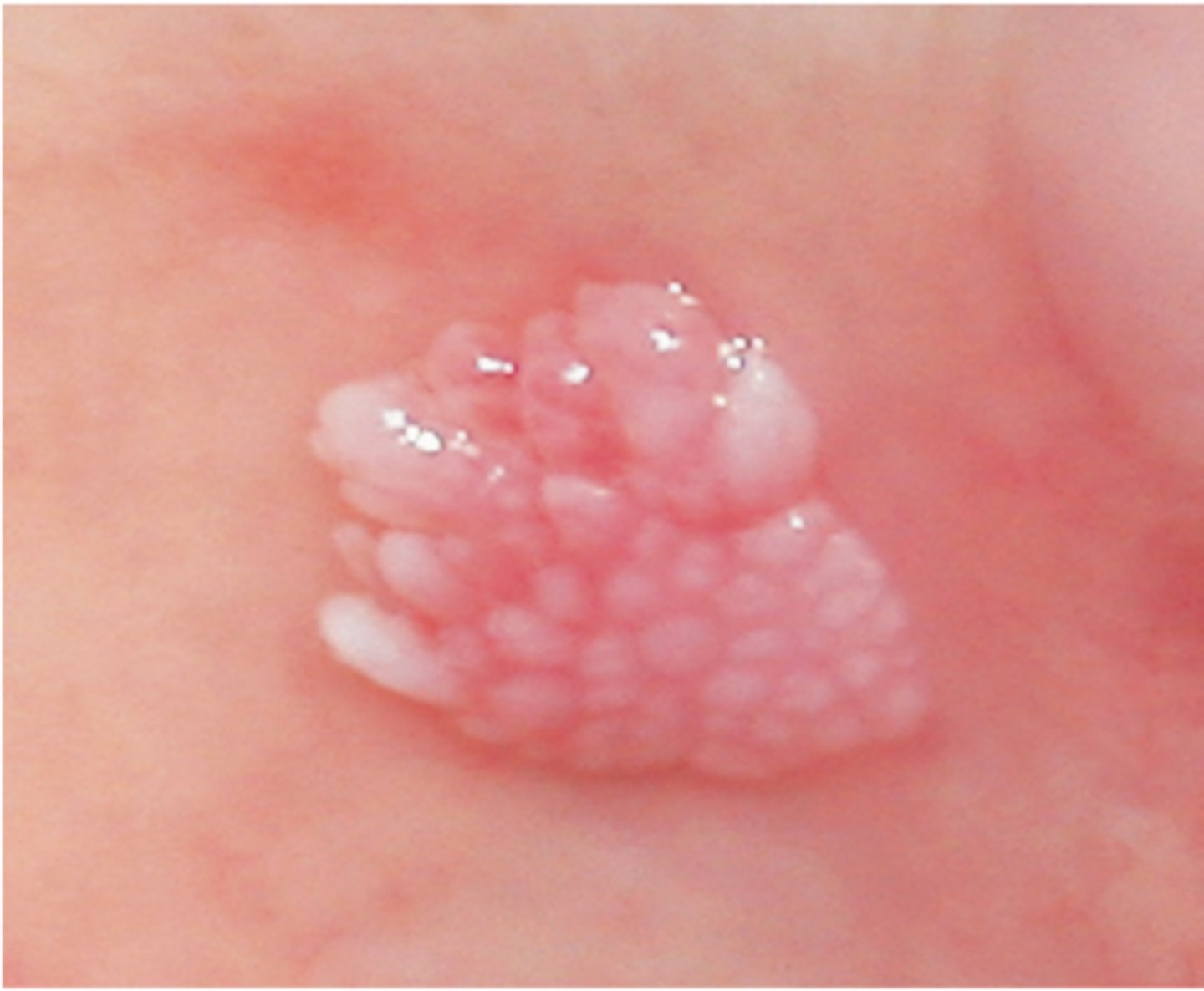 <p>Which benign epithelial lesion:</p><p>• Accumulation of lipid-laden</p><p>histiocytes called xanthoma cells</p><p>• Not associated with viruses, or</p><p>metabolic conditions</p><p>• Cause is unknown but likely a</p><p>reaction to trauma</p><p>• Asymptomatic</p><p>• Well-demarcated</p><p>• Sessile</p><p>• Slightly elevated mass</p><p>• Yellow, white, or red</p><p>• Papillary/roughened (verruciform) surface</p><p>• 50% on the gingiva or alveolar</p><p>mucosa</p><p>• Can mimic squamous cell</p><p>carcinoma</p>