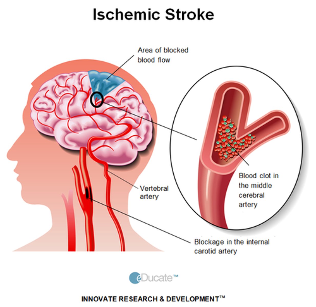 <p>• Embolisms and thrombosis</p><p>(MOI); brain is deprived of oxygen and glucose</p><p>• Risk factors: Dyslipidemia, diabetes, and smoking</p>
