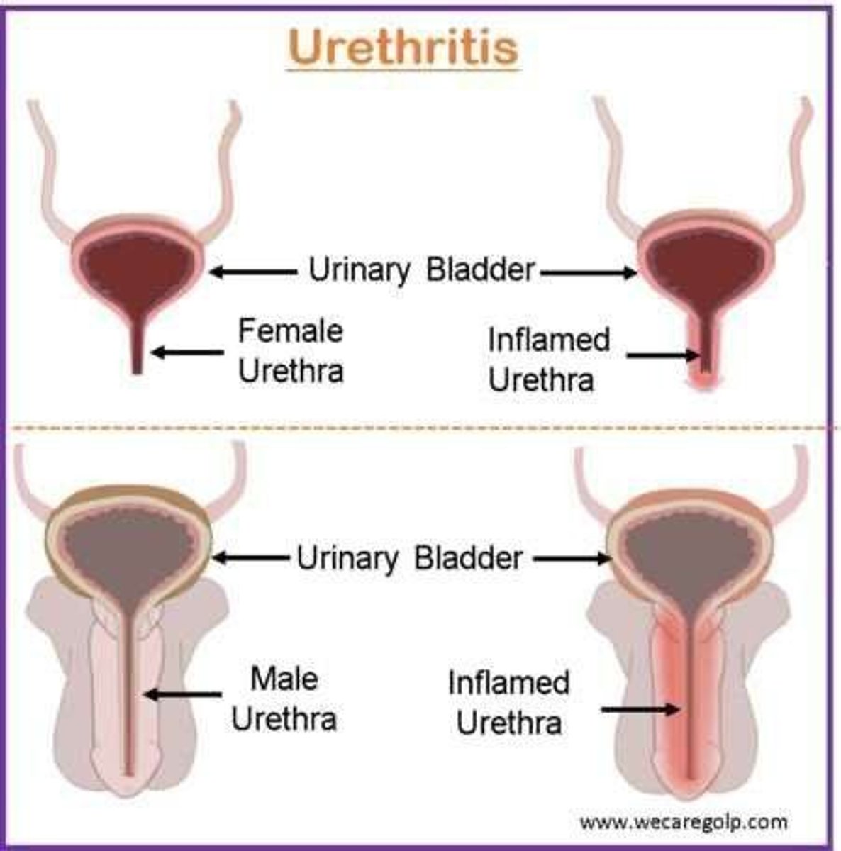 <p>Inflammation of the urethra; most common cause is Chlamydia trachomatis, but Neisseria gonorrhoeae, ureaplasmas, and mycoplasmas can also be the cause.</p>