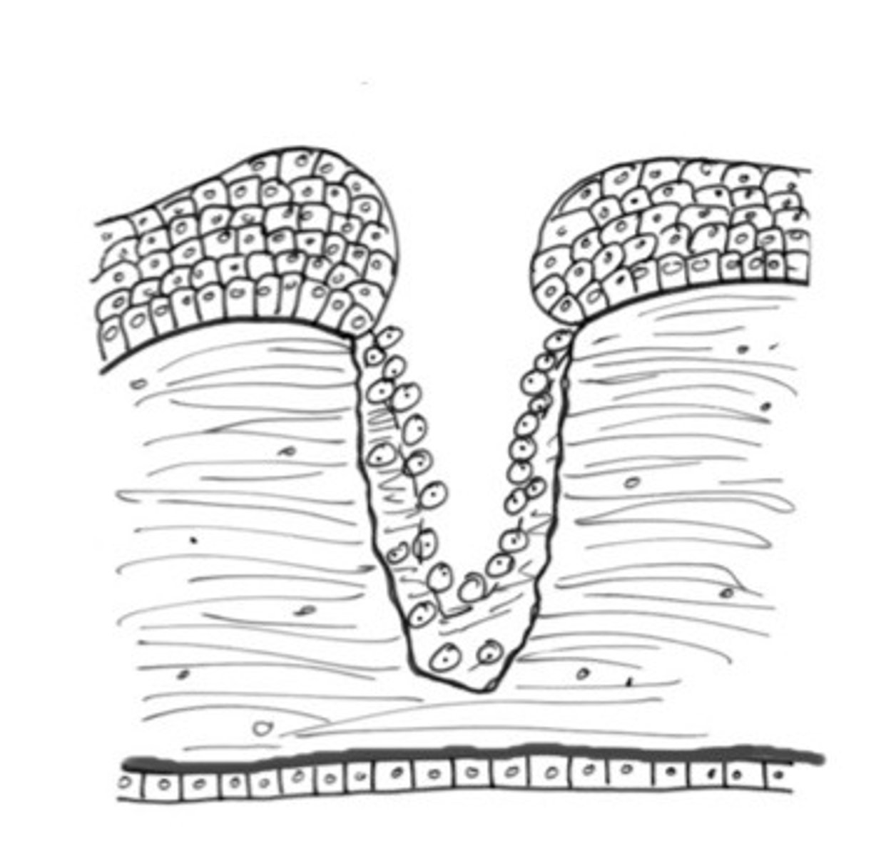 <p>Describe what type of cornea ulcer is happening here, where collagen is lost?</p>