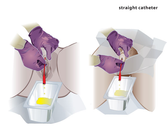<p>What are straight catheters used for?</p>