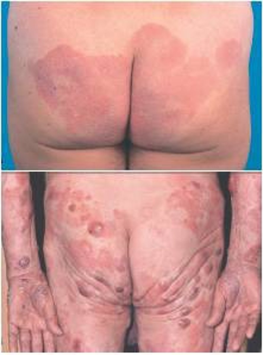<p>cutaneous T-cell lymphoma (malignancy of helper T-cells)</p>