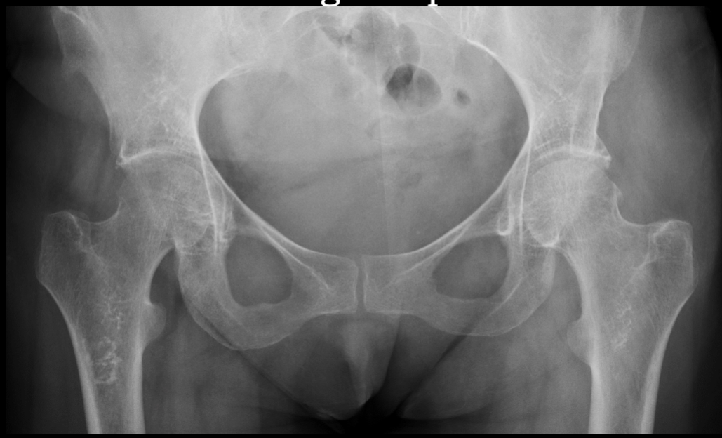 <p>what is seen here for this case of regional osteoporosis?</p>