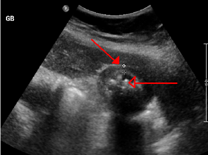 <p>Abd US, leukocytosis, mild elevation in AST/ALT, amylase, or bili</p>