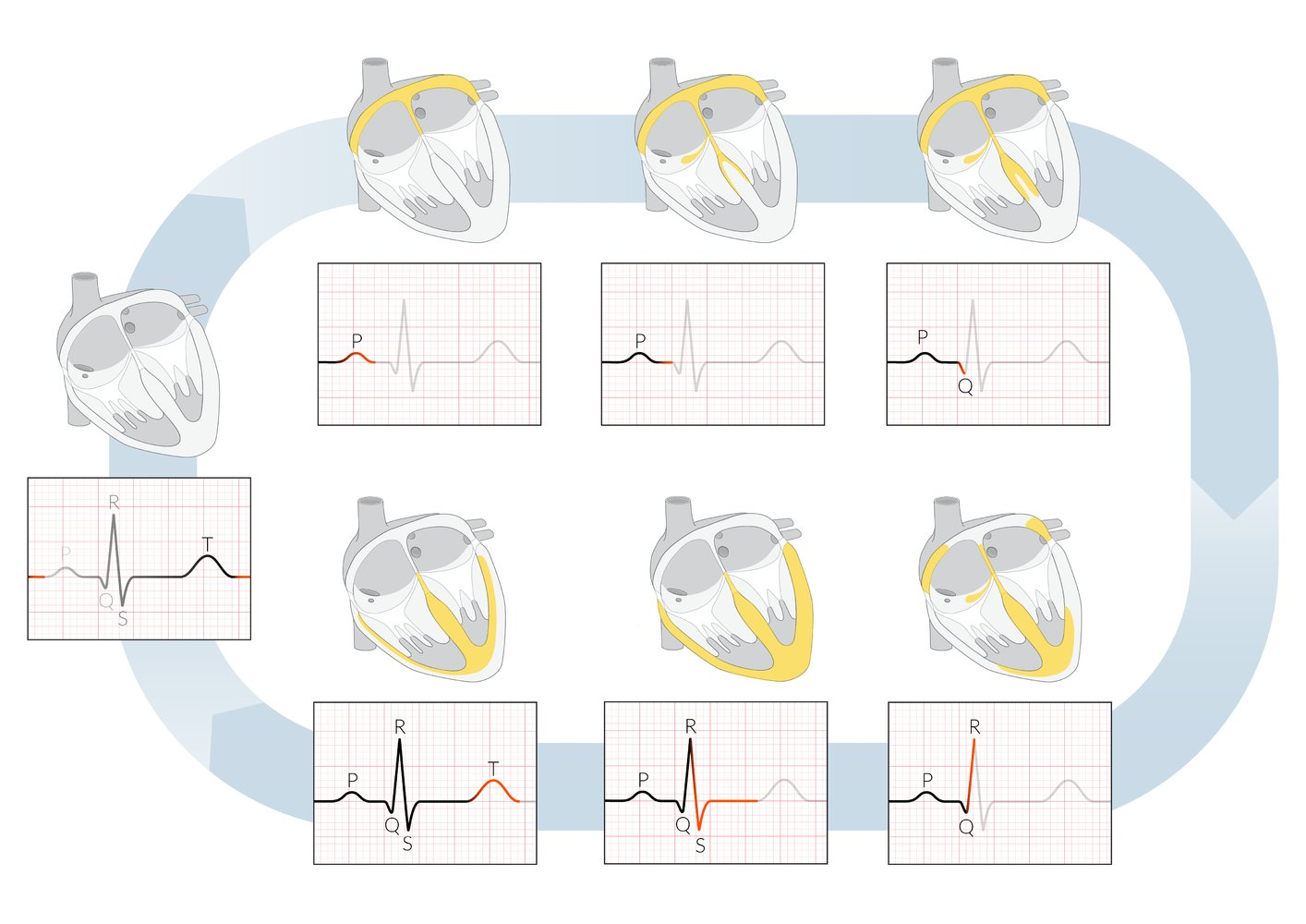 <p>D. By a prolonged QT interval</p>