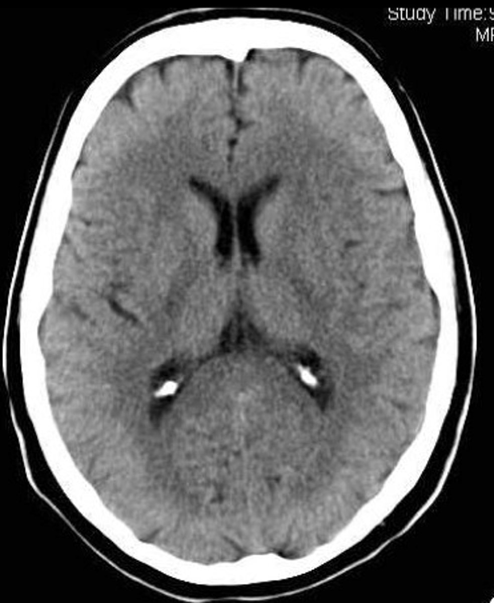 <p>Involves x-rays and creates an image through x-rays passing through varied densities within the brain.</p>