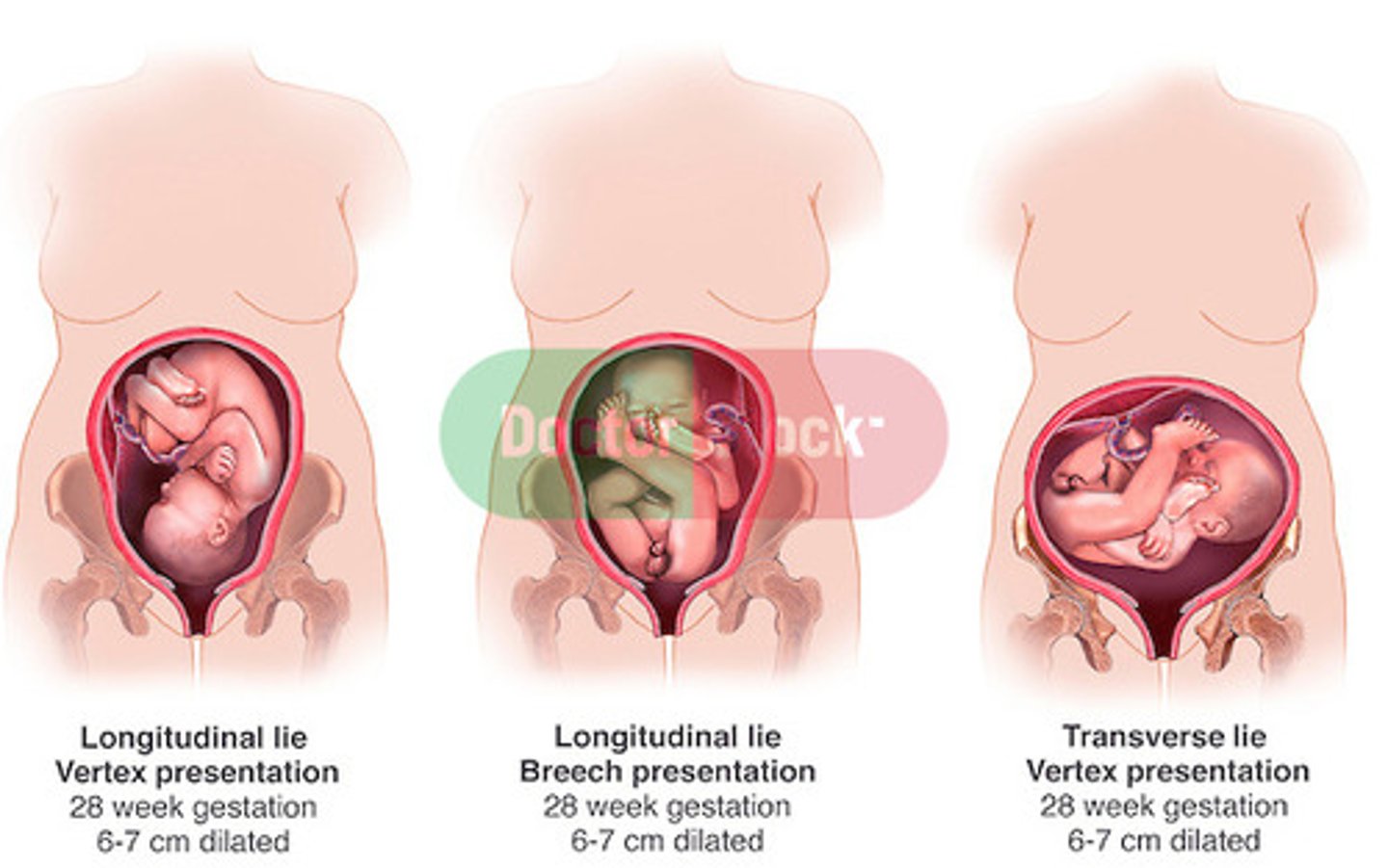 <p>orientation of the long axis of the fetus to the long axis of the woman</p><p>- longitudinal</p><p>- transverse</p><p>- oblique</p>