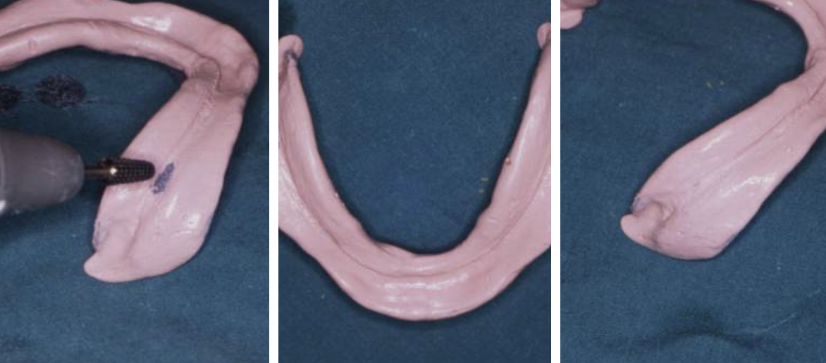 <p>how can a ZOE impression be adjusted if the tray penetrates through </p>