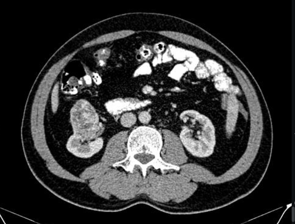 <p>Complex renal cyst findings on U/S and CT</p>
