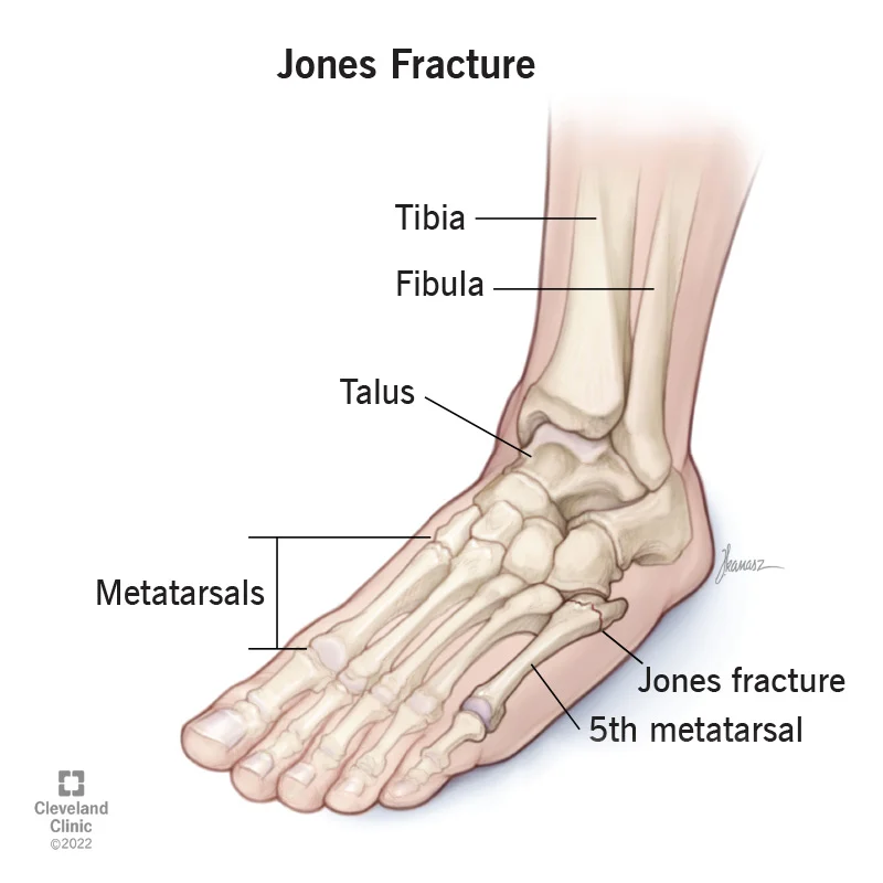 5th metatarsal base, avulsion fracture