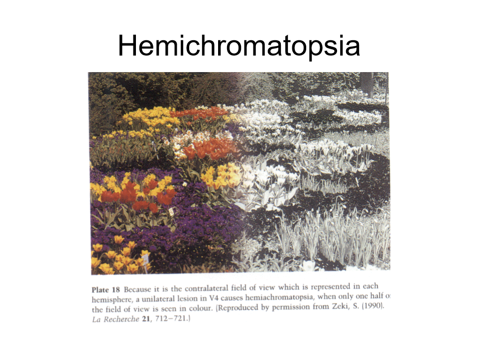 <p>half the visual field is not observed in colour, extrastriate lesion V4. </p>