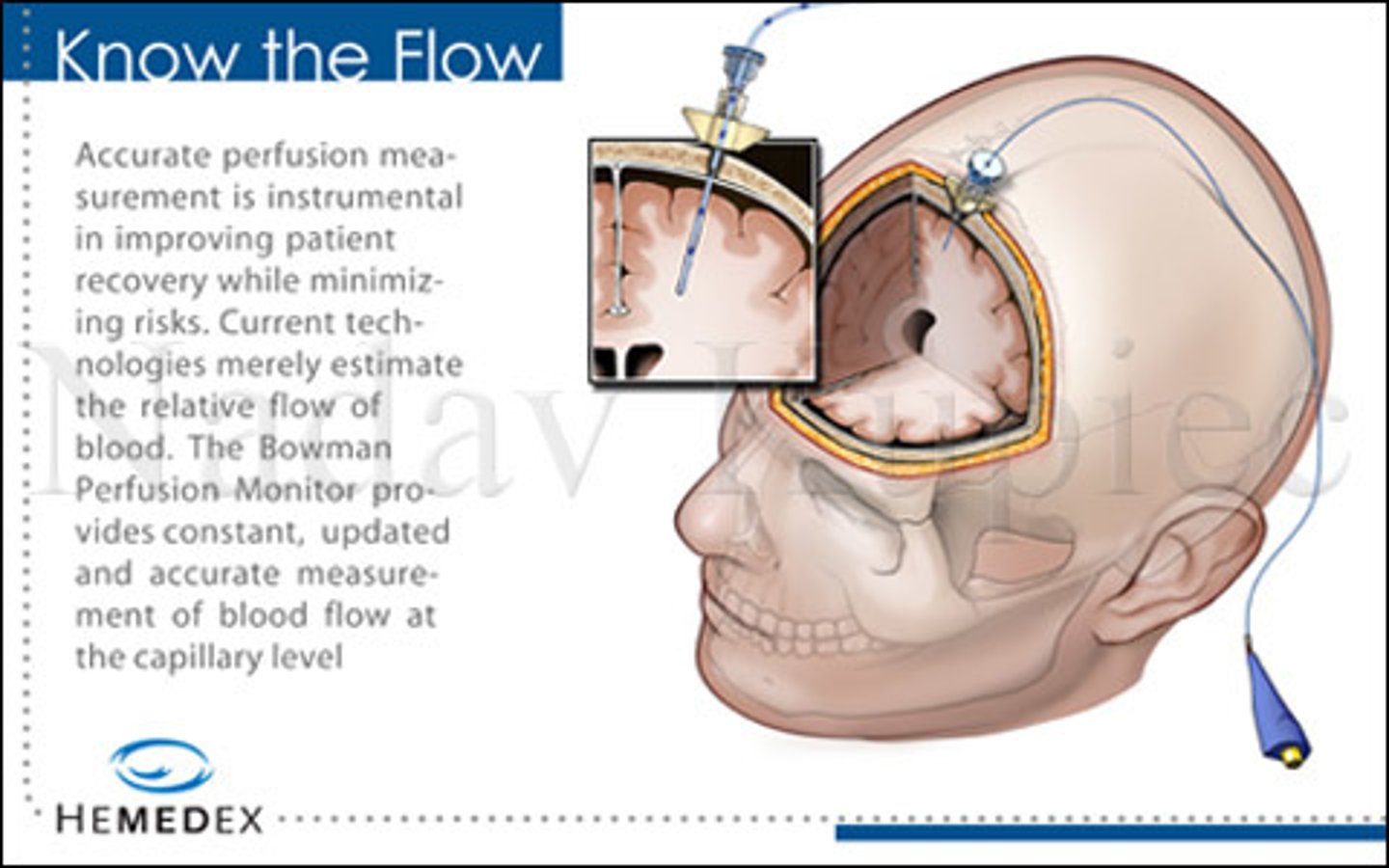 <p>Device placed in subarachnoid space and epidural sensor is placed between dura and skull</p>