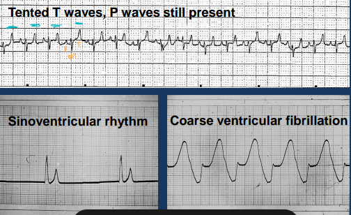 <ul><li><p><span style="background-color: transparent;"><strong>Et:</strong></span><span style="background-color: transparent; color: red;"><strong> <u>Urethral plug</u></strong></span><span style="background-color: transparent;"><strong>,</strong> struvite, Ca oxalate, neoplasia,</span><span style="background-color: transparent; color: blue;"> <strong><u>idiopathic</u></strong></span></p><ul><li><p><span style="background-color: transparent;"><u>↑ Intratubular pressure, ↓ GFR, ↓ Renal perfusion</u></span></p></li></ul></li><li><p><span style="background-color: transparent;"><strong>Cs: <u>early/partial</u>: </strong>stranguria, pollakiuria, hematuria, <strong><u>late/complete</u></strong>: vomiting, anorexia, <strong>Lg painful bladder- difficult to express</strong>, <u>resistance to catheterization,</u> arrythmias</span></p><ul><li><p><span style="background-color: transparent;">Acute reversible oliguric renal failure</span></p></li></ul></li><li><p><span style="background-color: transparent;"><strong>Dt:</strong> </span><span data-name="arrow_up_down" data-type="emoji">↕</span><span style="background-color: transparent;"><u> Azotemia, ↑ P, </u><strong><u>↑ K</u></strong><u> (Tented T), </u><strong><u>met.</u></strong><u> </u><strong><u>acidosis</u></strong><u>, ↓ Na, Ca</u></span></p><ul><li><p>Normal P range = 2.5-5.5 mg/dl</p></li></ul></li><li><p><span style="background-color: transparent;"><strong>Tx:</strong> Fix ↑ K, BES fluids, decompressive <u>cystocentesis, hydropulpulsion, analgesia, catheter + pain meds, perineal urethrostomy (>3 reoccurances)</u></span></p><ul><li><p><span style="background-color: transparent;"><strong>Med emerg: complete obst. → </strong>Uremia + death 3-5d w/o tx, <strong><u>self limiting diuresis 2-7d post </u></strong></span></p><ul><li><p><span style="background-color: transparent;"><u>Treat while running tests </u></span></p></li><li><p><span style="background-color: transparent;"><strong><u>Sx does not prevent reoccurance or FIC</u></strong></span></p></li></ul></li></ul></li><li><p>Balanced electrolyte solutions (e.g. lactated Ringers solution, Normosol-R) but can use NaCl if you have to</p></li></ul><p></p>