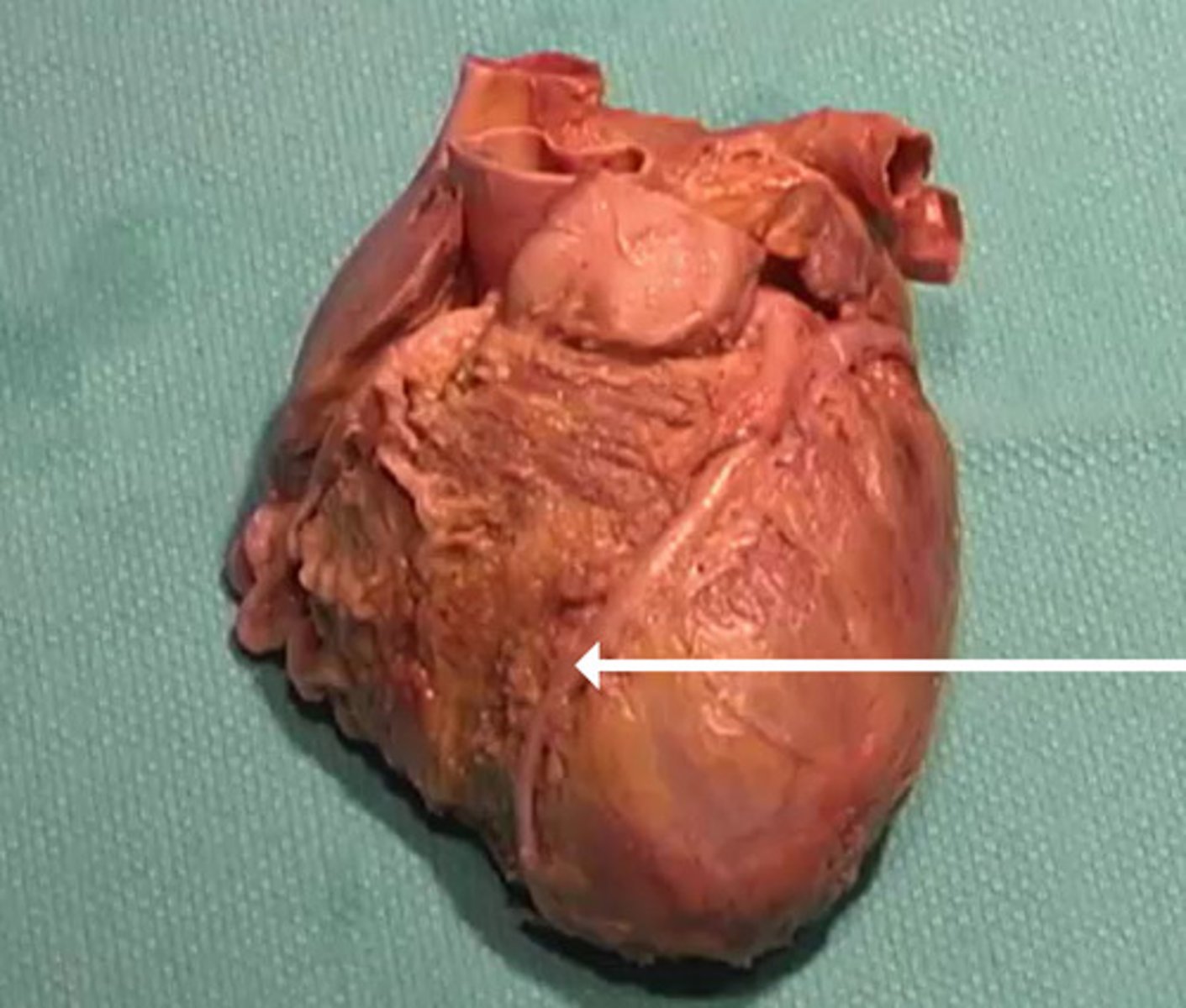 <p>To what structure is the arrow pointing?</p><p>aorta</p><p>anterior interventricular artery</p><p>right atrium</p><p>left cornary artery</p>