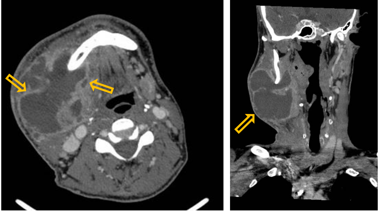 <p>Patient history: right lower wisdom-tooth extraction 6 days ago, painful swollen mass on the right side of the masticator region</p><p>Modality: Contrast-enhanced CT, left image – axial view; right image – coronal reconstruction, iv. iodine-based contrast agent</p><p>Region: neck, axial (left) and coronal (right) views</p><p>Radiologic sign: Right-sided, hypodense submandibular fluid collection with thick, enhancing wall (yellow arrow). Fluid inside the abscess has a density of 0-10 HU and shows no enhancement. Patient had prior wisdom tooth extraction. </p><p>Diagnosis: neck abscess</p>