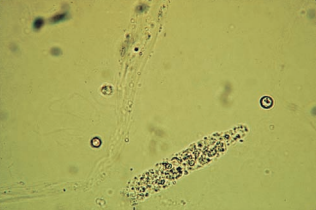 An RBC cast accompanied by RBCs