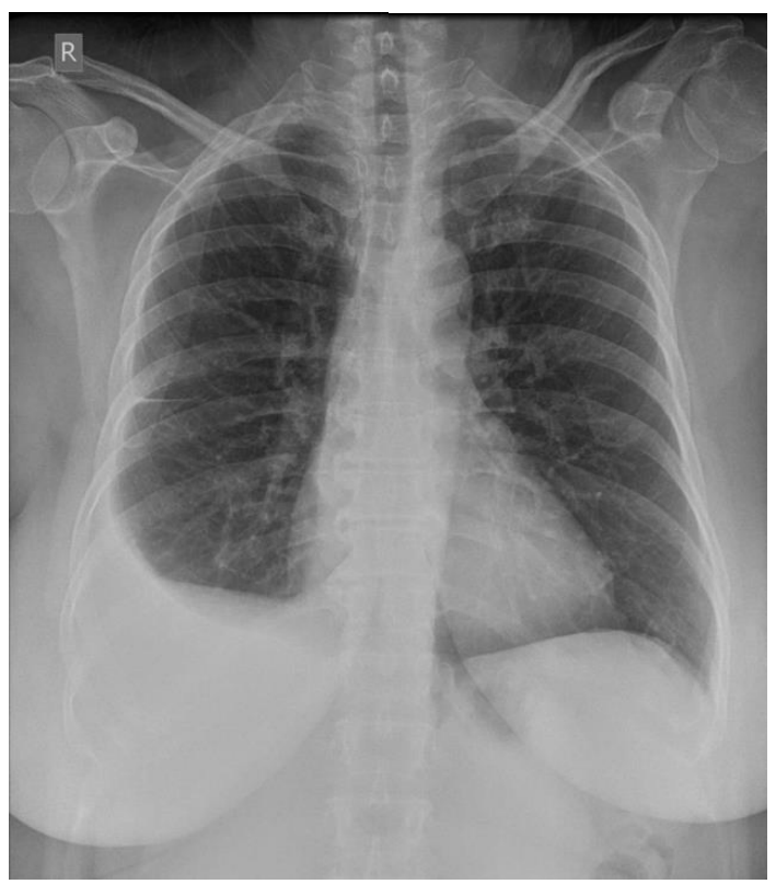 <p>A chest radiograph from a 60-year-old female reveals the result shown in the accompanying image. Her medical history is significant for breast cancer 8 years ago for which she received chemo and radiation therapy. To remove this fluid, thoracocentesis should be performed at which of the following locations?</p><p>A. Midaxillary line, 6th intercostal space</p><p>B. Midaxillary line, 9th intercostal space</p><p>C. Midclavicular line, 4th intercostal space</p><p>D. Midclaviculiar line, 10th intercostal space</p><p>E. Scapular line, 6th intercostal space</p><p>F. Scapular line, 8th intercostal space</p>
