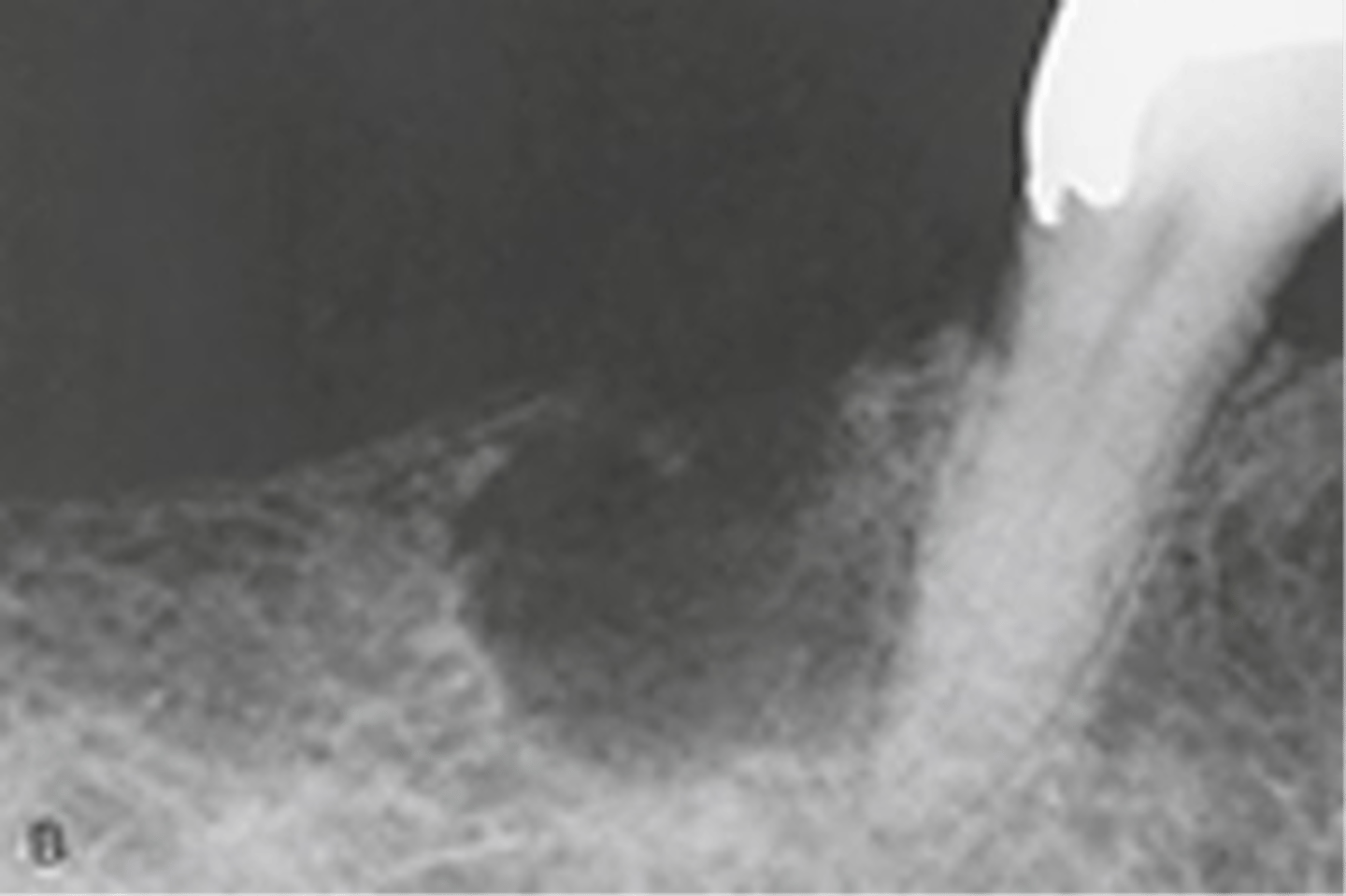 <p>most common >40</p><p>may have calcifications</p>