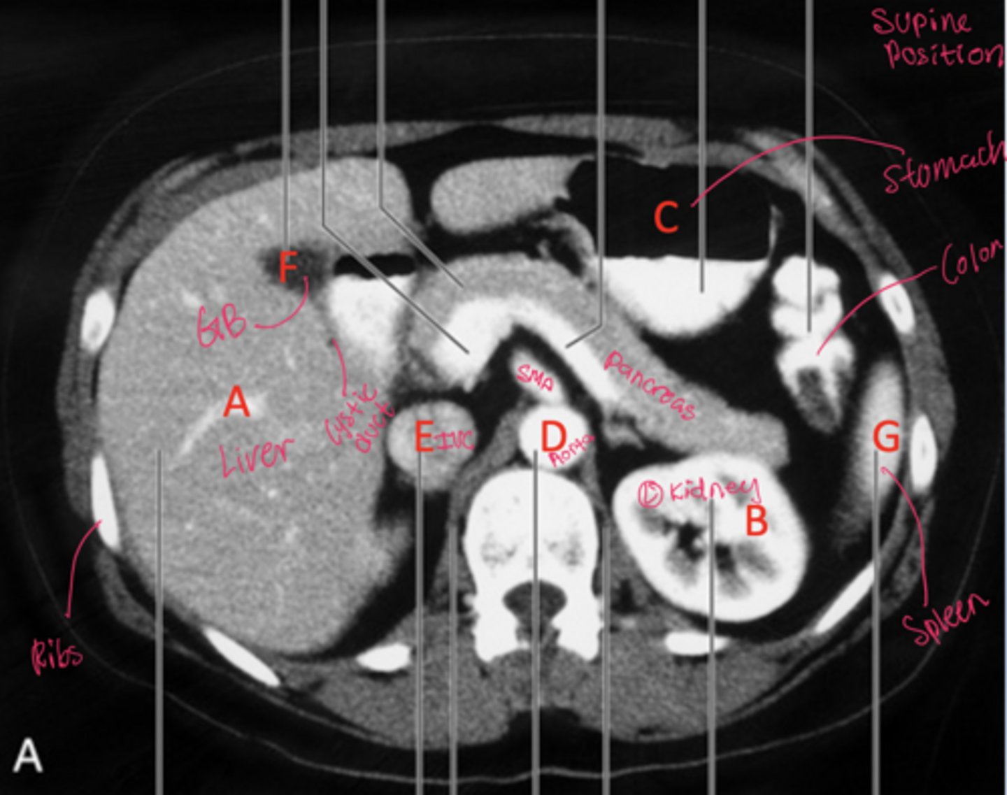 <p>Fluid collects posteriorly (toward the back) and air collects anteriorly.</p>