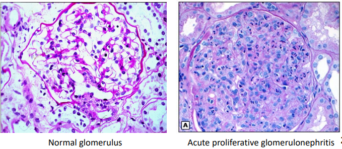 <p>Compare the glomeruli in these light microscopy images:</p><ul><li><p>Poorly defined capillary loops</p></li><li><p>Increased number of cells</p></li></ul><p></p>