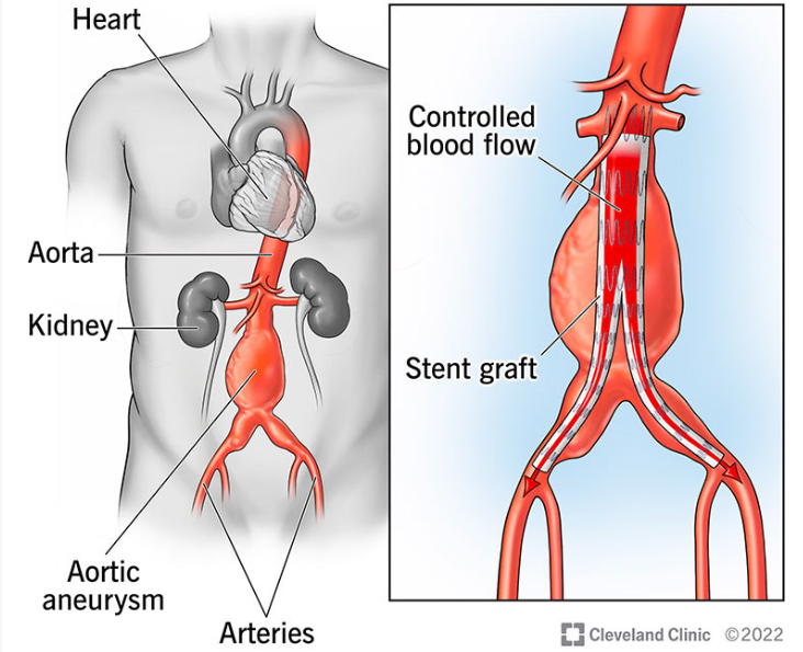 <p>**repairs AAA w stent graft (groin-AO)</p><p><u>type I:</u> incomplete seal at ends</p><p><u>type II:</u> sac fill via branch vessel (retrograde)</p><p><u>type III:</u> stent defect/tear</p><p><u>type IV:</u> porous graft</p><p><u>type V:</u> AAA expansion w/out leak site</p>