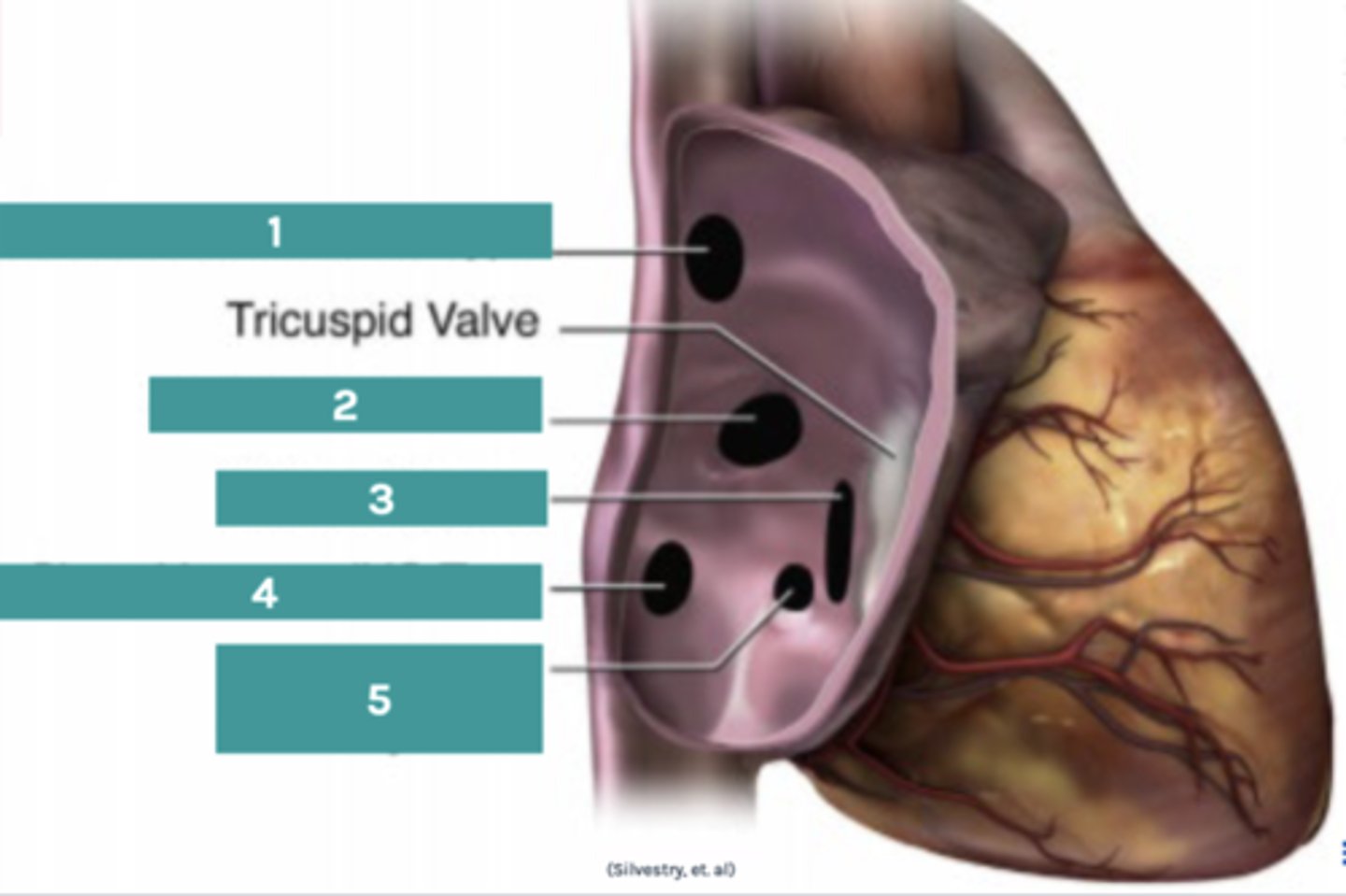 <p>1. Sinus venosus ASD</p><p>2. Secundum ASD</p><p>3. Primum ASD</p><p>4. Sinus venosus ASD</p><p>5. Coronary sinus ASD</p>