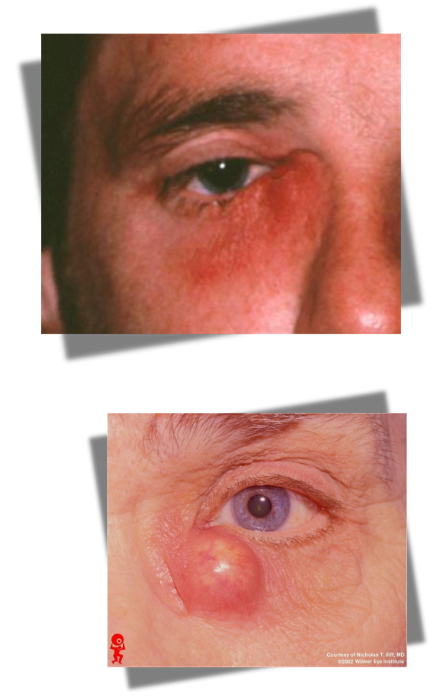 <p>infection of lacrimal sac</p>