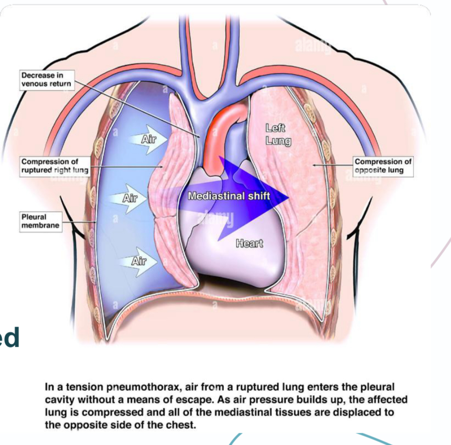<p>Severe dyspnea (ipslateral lung is collapsed, contralateral lung is pressurized), cyanosis (heart is compressed so less O2) and hypotension (due to reduced venous return) leading to death</p>