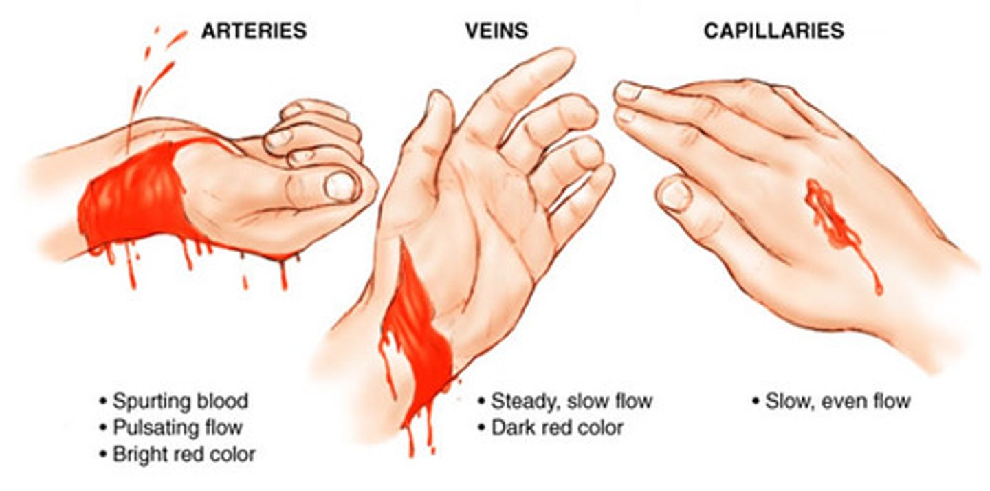 <p>Exudate that contains blood</p><p>hemorrhage = bleeding</p>