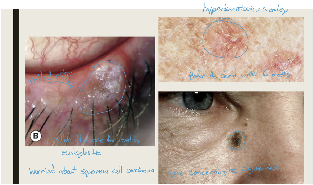 <p>Excision or cryotherapy with biopsy</p>
