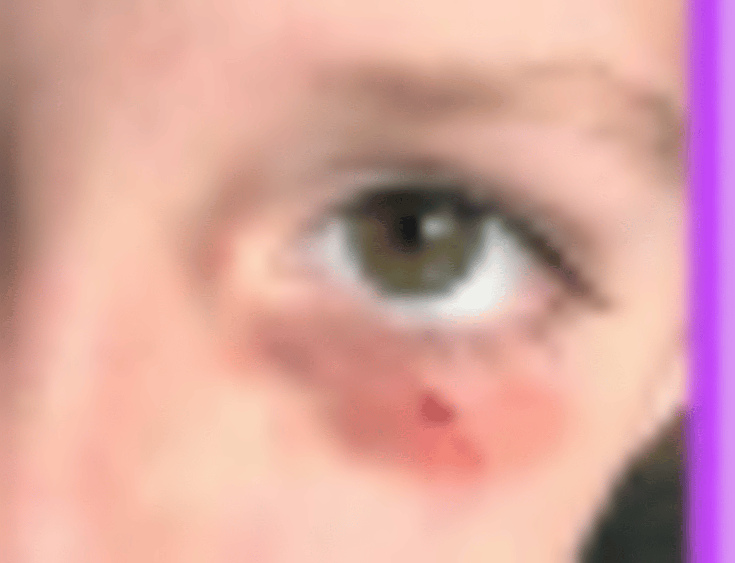 <p>cross midline</p><p>rapid eye movements and myoclonus</p><p>"racoon" eyes</p>