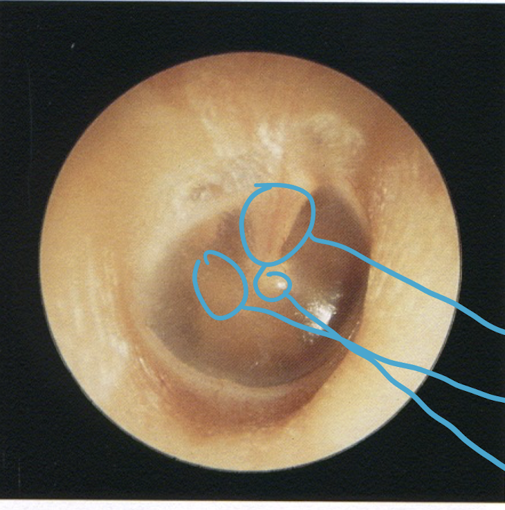 <p><u>healthy ear drum</u></p><p>top circle</p>