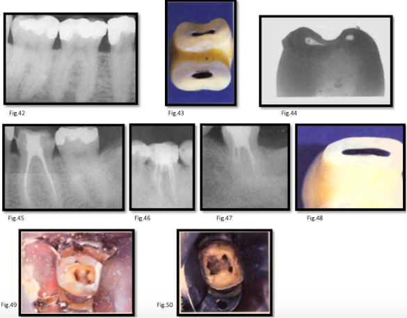 <p>canal anatomy of <strong>mn 1st molar</strong></p>