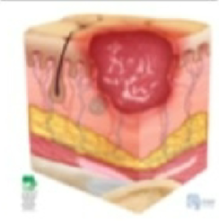 <p>Skin is broken on the top layers of skin only </p>