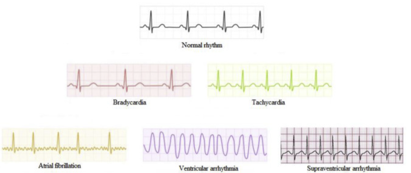 <p>Normal Sinus Rhythm</p>