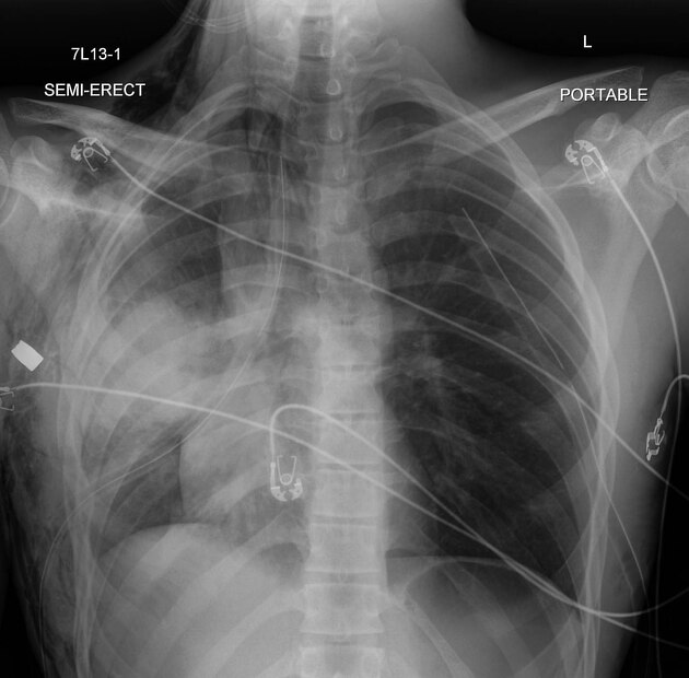 <p>Describe the abnormality demonstrated (gunshot wound). </p>