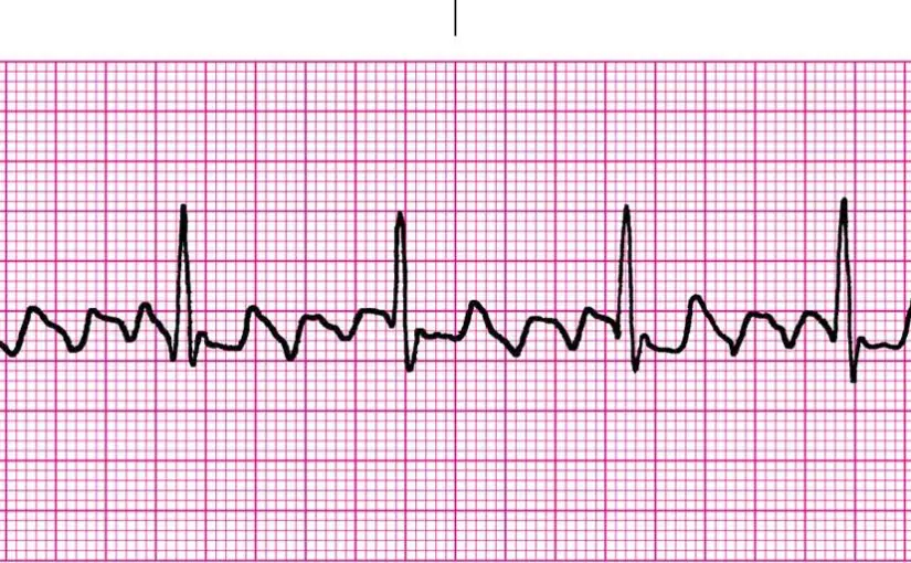 <ul><li><p>narrow complex tachycardia</p></li><li><p>regular atrial activity @ ~300 BPM</p></li><li><p>loss of isoelectric baseline</p></li><li><p>sawtooth pattern and inverted at II, III, AVF</p></li></ul><p></p>