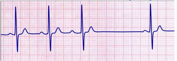 <p>What does this EKG show?</p>