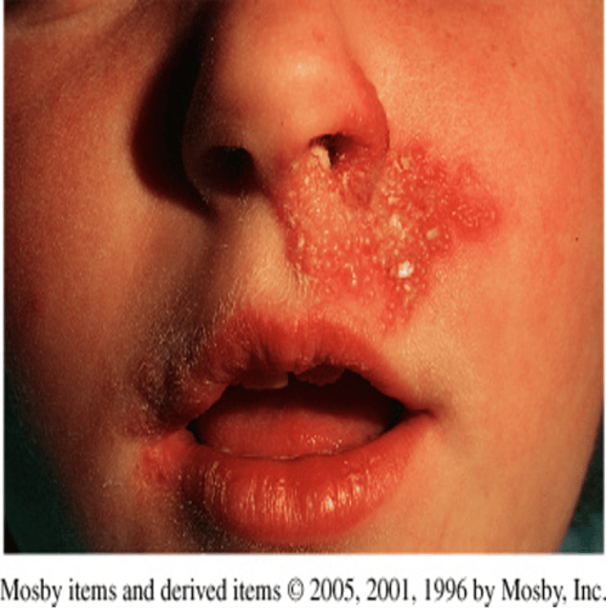 <p>-Chronic non-curable condition transmitted by contact</p><p>-Outbreaks can be triggered by sun, stress, and fever</p><p>-Highly contagious lesions (direct contact)</p><p>-Cold sores</p>