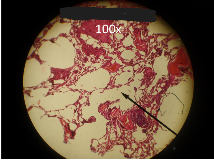 <p>What condition is shown here?</p><p>a. asthma b. black lung c. lung carcinoma d. emphysema e. tuberculosis</p>