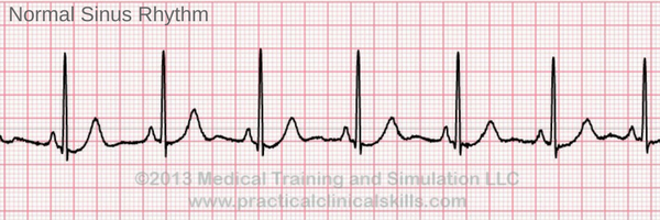 <p>normal sinus rhythm (NSR) refers to the cardiac rhythm that is presented by a normal, healthy heart. It has a rate between 60 to 100 beats per minute and typically shows beats at equal intervals from one another</p>