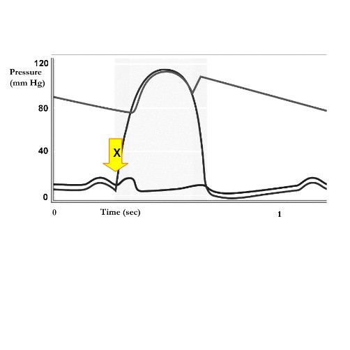 <p><span>The curves represent aortic, left ventricular, and left atrial pressure levels over time. At time X, the valve condition change in progress is:</span></p>