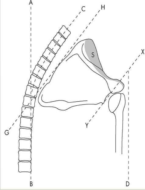 <ol><li><p><strong><u>Subluxation</u></strong></p><ol><li><p><strong><u>shoulder muscles are initially weak</u></strong></p></li><li><p>—&gt; <strong><u>followed by gravity continuing to actively pull it down</u></strong></p></li></ol></li><li><p><strong><u>Abnormal Scapulohumeral Rhythm</u></strong></p></li><li><p><strong><u>Pain and Impingement</u></strong></p><ol><li><p><strong><u>scapula can’t get out of the way when the shoulder goes into flexion</u></strong></p></li><li><p>—&gt; <strong><u>followed by pain and impingement&nbsp;</u></strong></p></li></ol></li><li><p><strong><u>Ineffective &amp; Inefficient Movement Patterns</u></strong></p></li><li><p><strong><u>Possible SHS (shoulder hand syndrome)/CRPS</u></strong></p></li><li><p><strong><u>Decreased Function</u></strong></p></li></ol><p>image</p><ul><li><p>A-B: neutral</p></li><li><p>C-B: lateral flexion</p></li></ul><p></p>