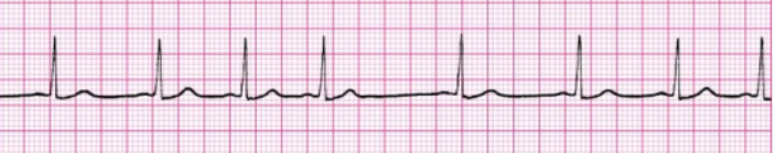 <p>Determine the sinus node arrhythmia: </p><p>abnormal rhythm and irregular</p>